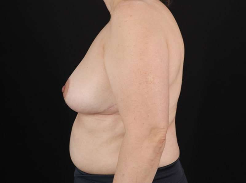 Breast Reduction Before & After Patient #2706