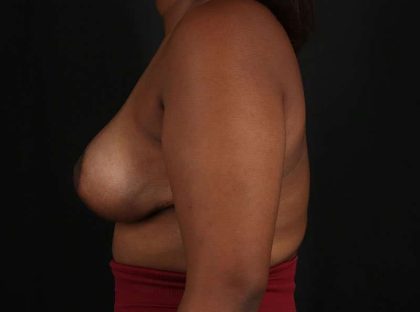 Breast Reduction Before & After Patient #2729
