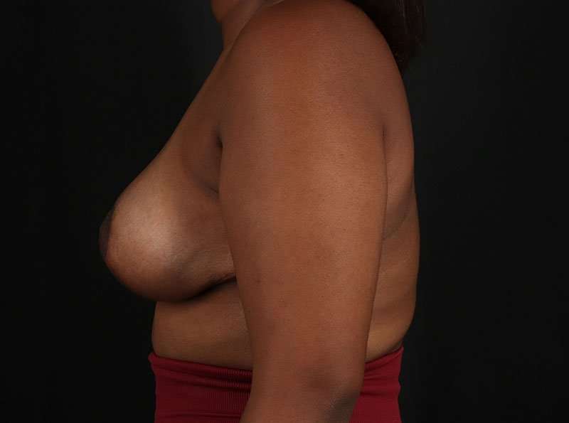 Breast Reduction Before & After Patient #2729