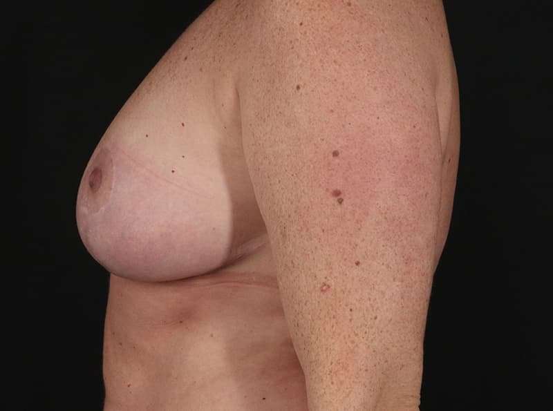 Breast Reduction Before & After Patient #2754