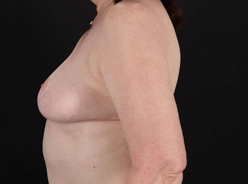 Breast Reduction Before & After Patient #2766