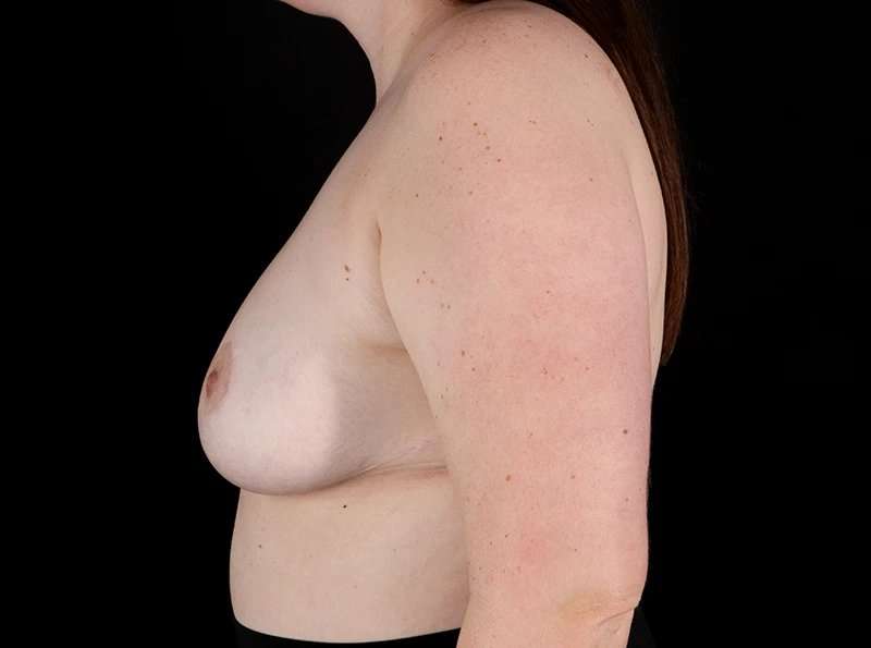 Breast Reduction Before & After Patient #2802