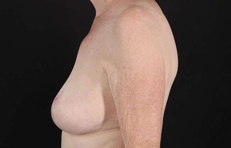 Breast Reduction Before & After Patient #2836