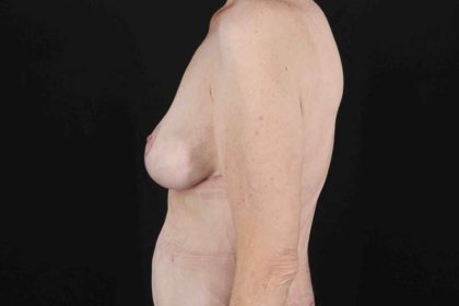Breast Reduction Before & After Patient #2847