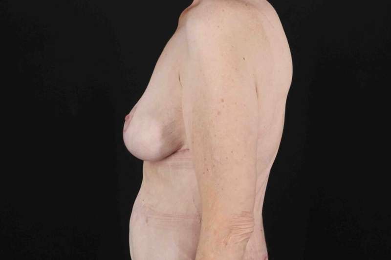 Breast Reduction Before & After Patient #2847