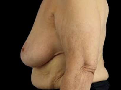 Breast Reduction Before & After Patient #2859