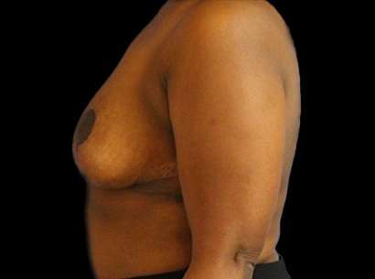 Breast Reduction Before & After Patient #2870