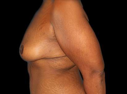Breast Reduction Before & After Patient #2881