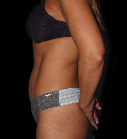 Abdominoplasty (Tummy Tuck) Before & After Patient #757