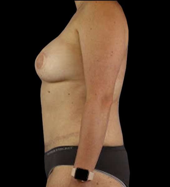 DIEP Flap Before & After Patient #2954