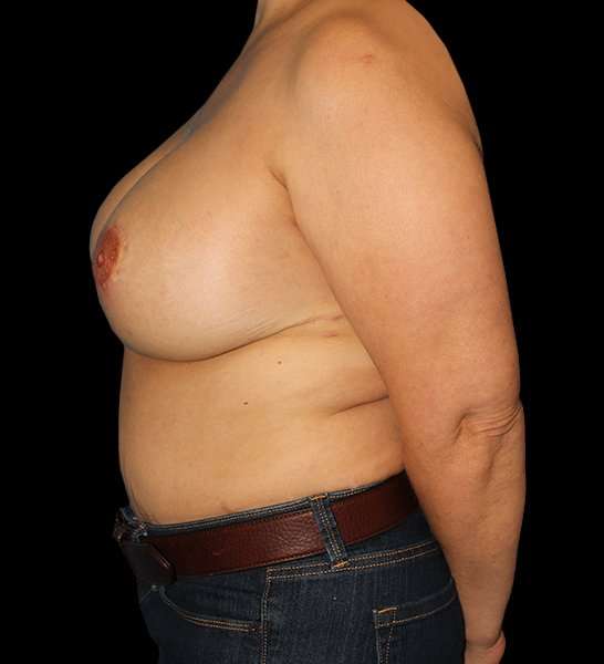 DIEP Flap Before & After Patient #2974