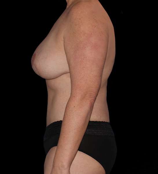 DIEP Flap Before & After Patient #2989