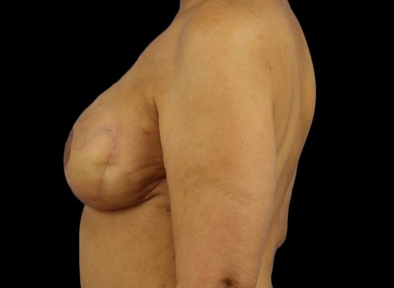 DIEP Flap Before & After Patient #3030