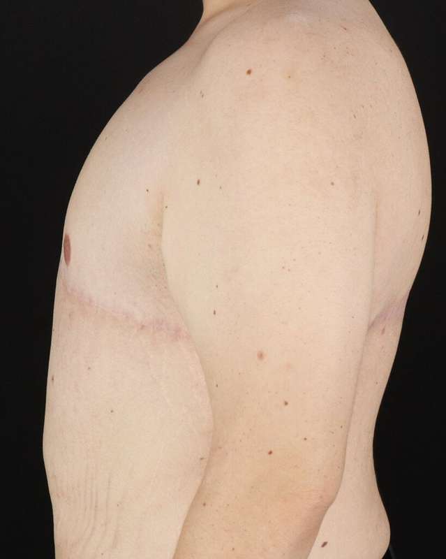 Gynecomastia Before & After Patient #3162