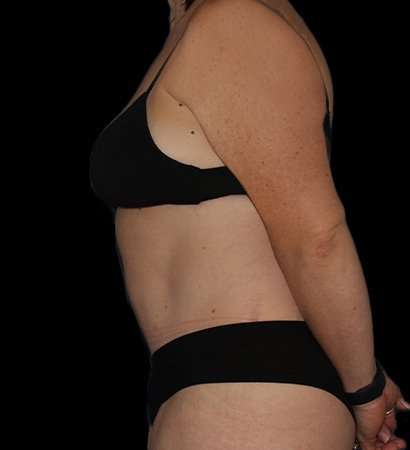 Abdominoplasty (Tummy Tuck) Before & After Patient #768