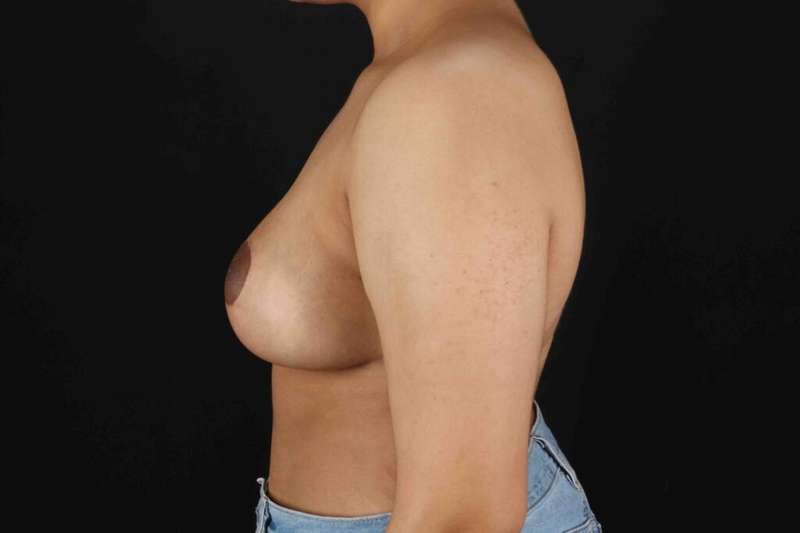 Breast Reduction With Lift Before & After Patient #3301