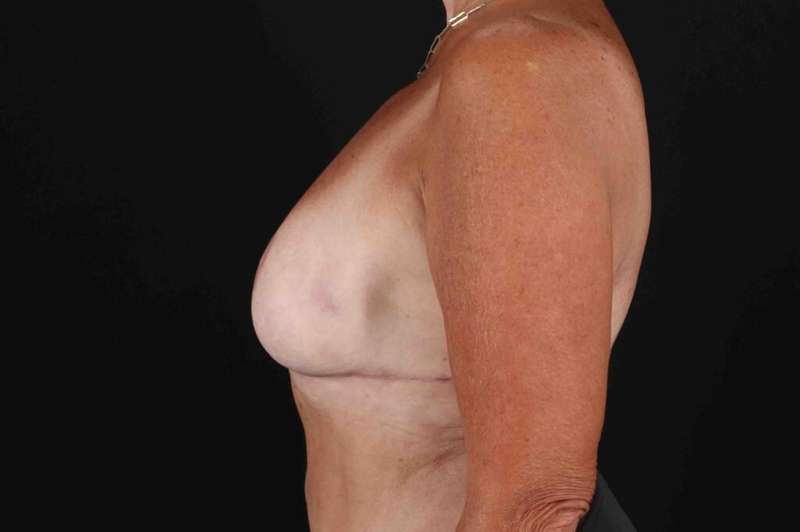 Breast Reduction With Lift Before & After Patient #3312