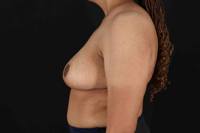 Breast Reduction With Lift Before & After Patient #3323