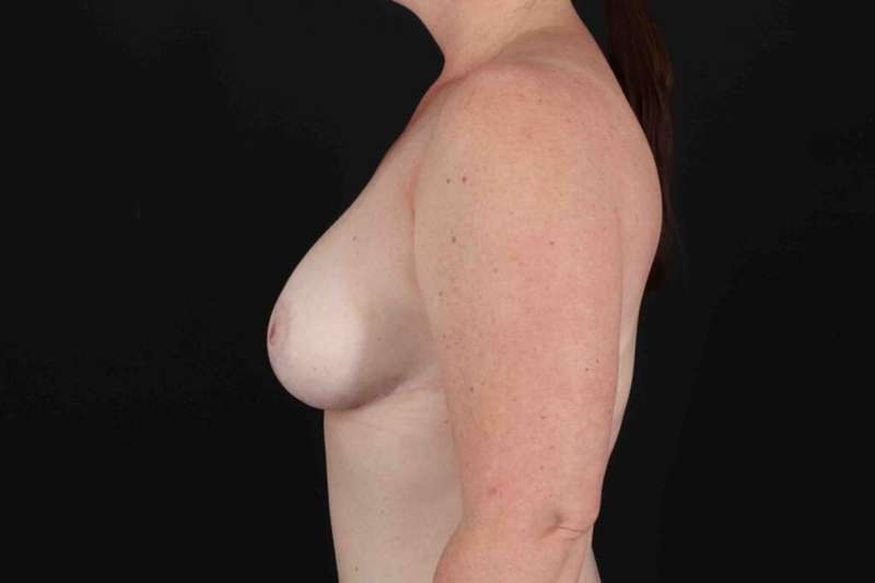 Breast Reduction With Lift Before & After Patient #3356