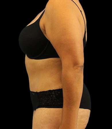 Abdominoplasty (Tummy Tuck) Before & After Patient #779