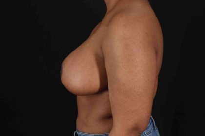 Breast Reduction With Lift Before & After Patient #3400