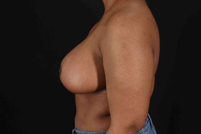 Breast Reduction With Lift Before & After Patient #3400