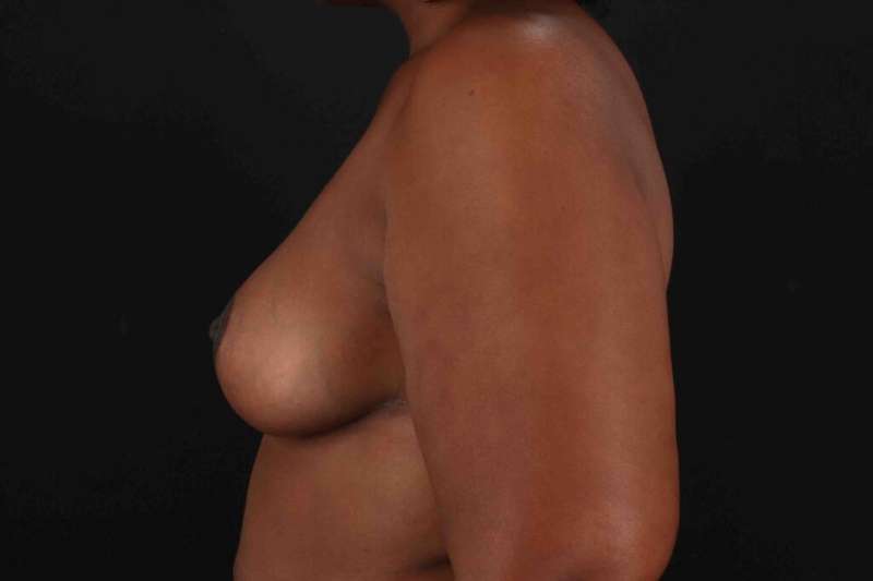 Breast Reduction With Lift Before & After Patient #3411