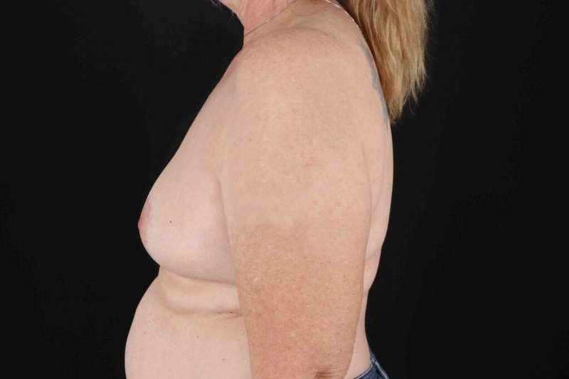Breast Implant Removal Before & After Patient #3483