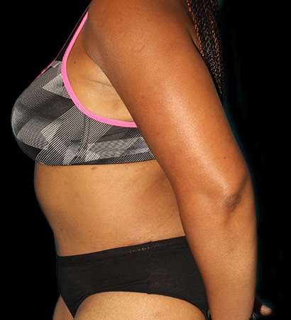 Abdominoplasty (Tummy Tuck) Before & After Patient #790