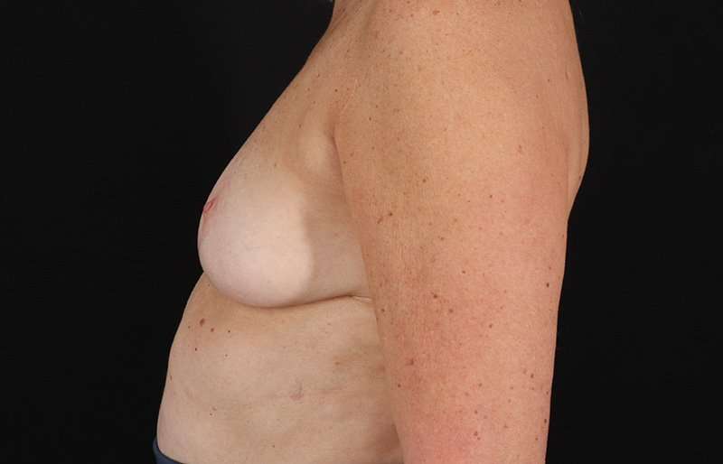 Breast Implant Removal Before & After Patient #3516