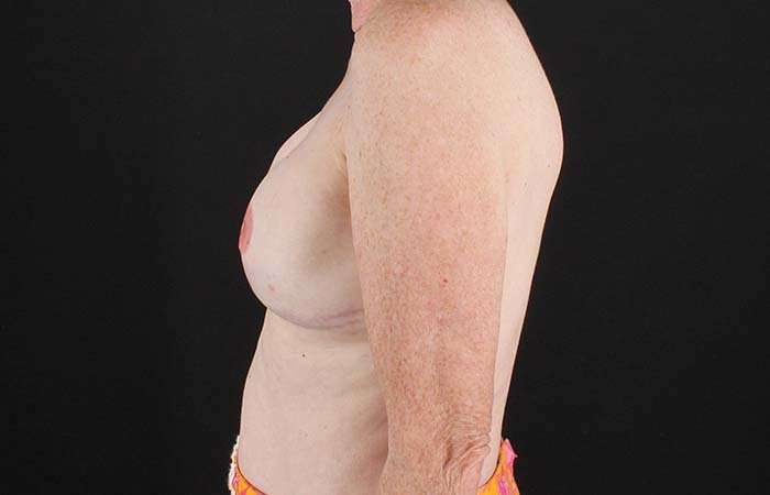 Implant Based Reconstruction Before & After Patient #3527