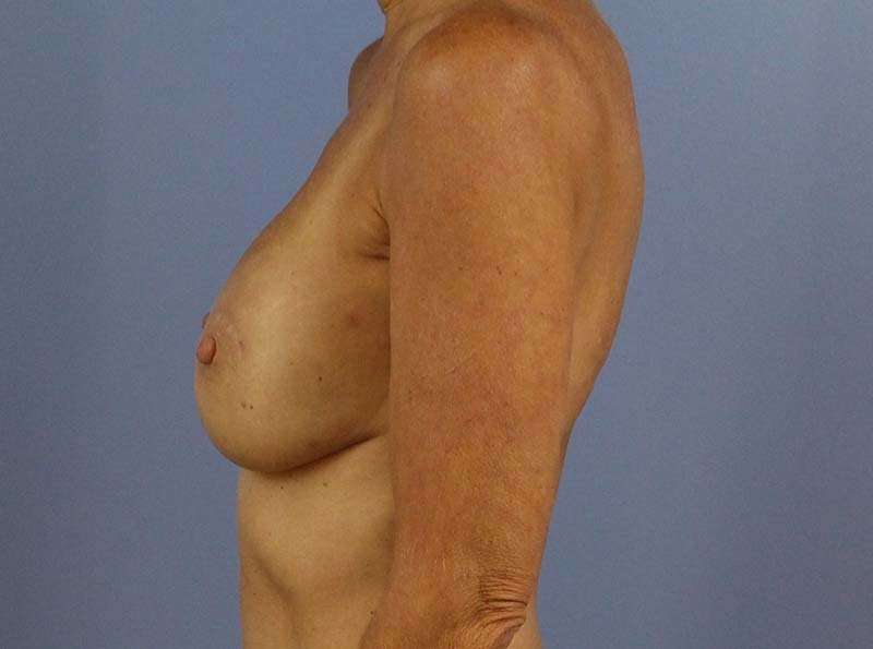 Implant Based Reconstruction Before & After Patient #3538
