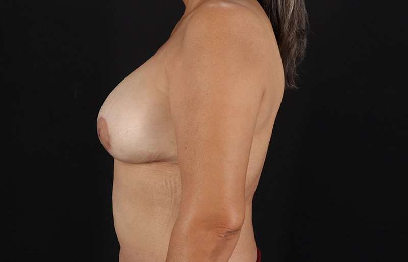 Implant Based Reconstruction Before & After Patient #3560