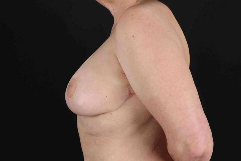 Breast Lift Before & After Patient #3571