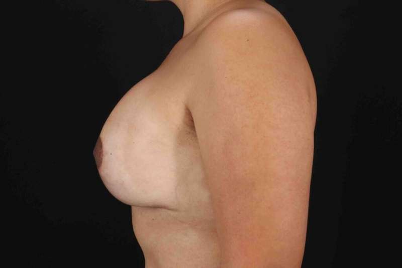 Breast Lift Before & After Patient #3717