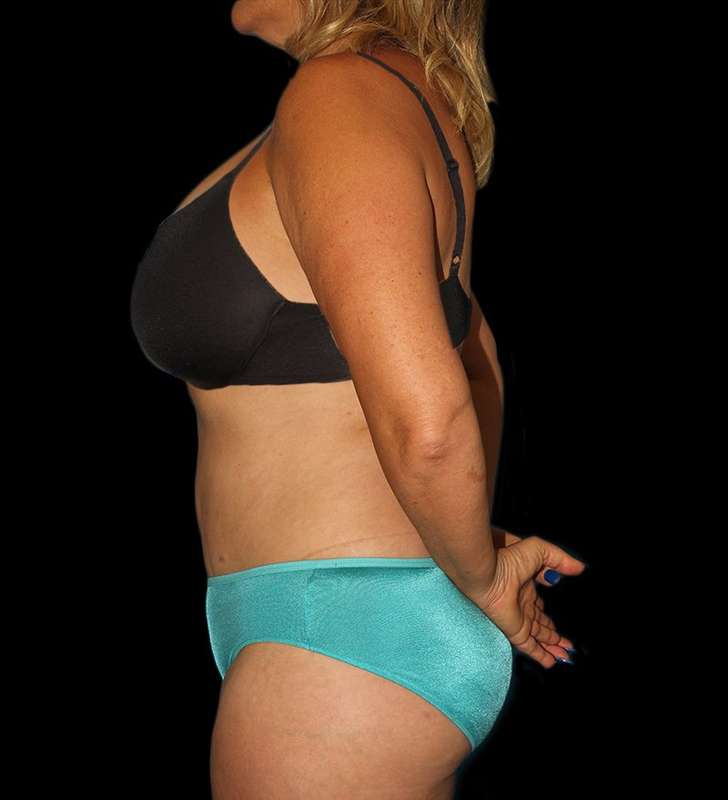 Abdominoplasty (Tummy Tuck) Before & After Patient #579