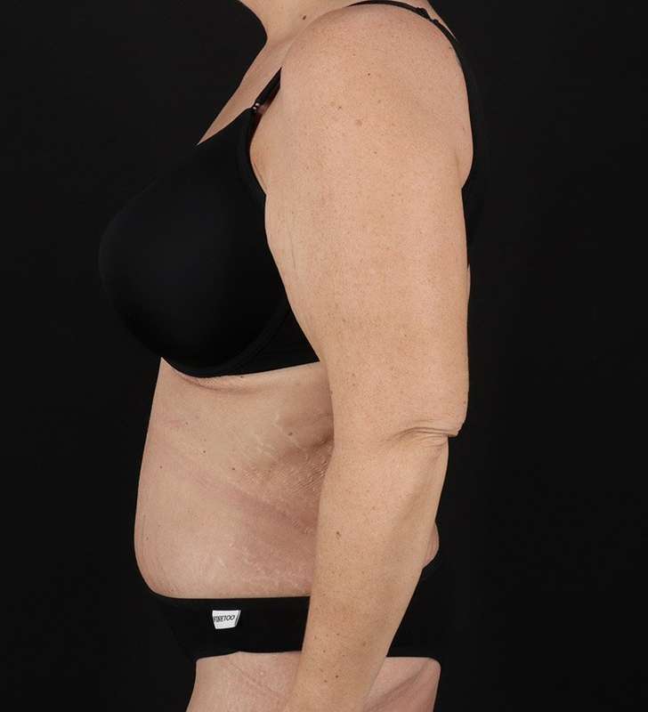 Abdominoplasty (Tummy Tuck) Before & After Patient #817