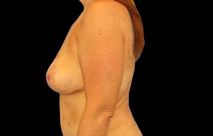Breast Lift Before & After Patient #3761