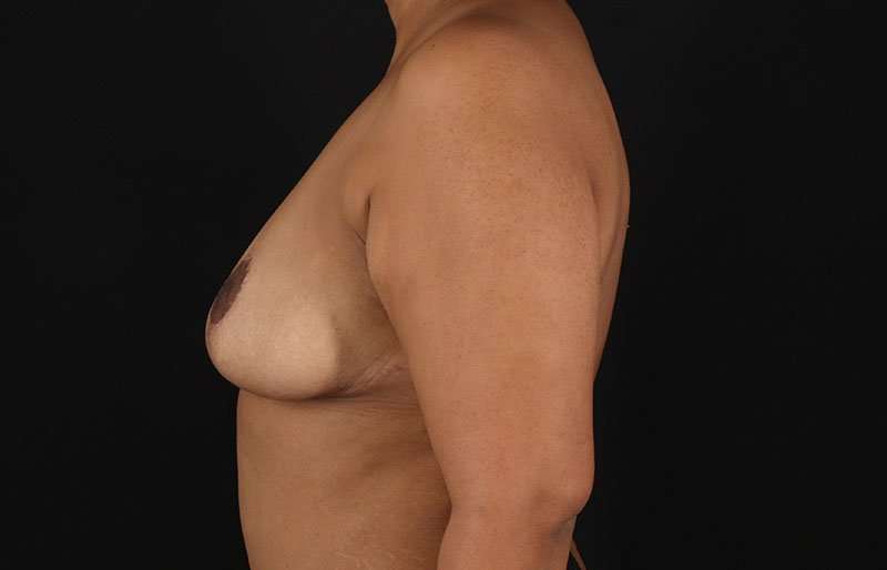 Breast Lift Before & After Patient #3820