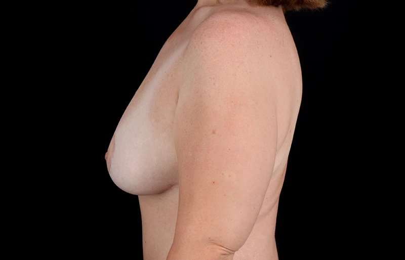 Breast Lift Before & After Patient #3831