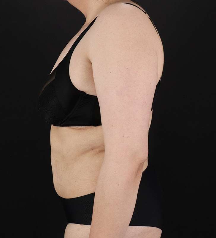 Abdominoplasty (Tummy Tuck) Before & After Patient #830