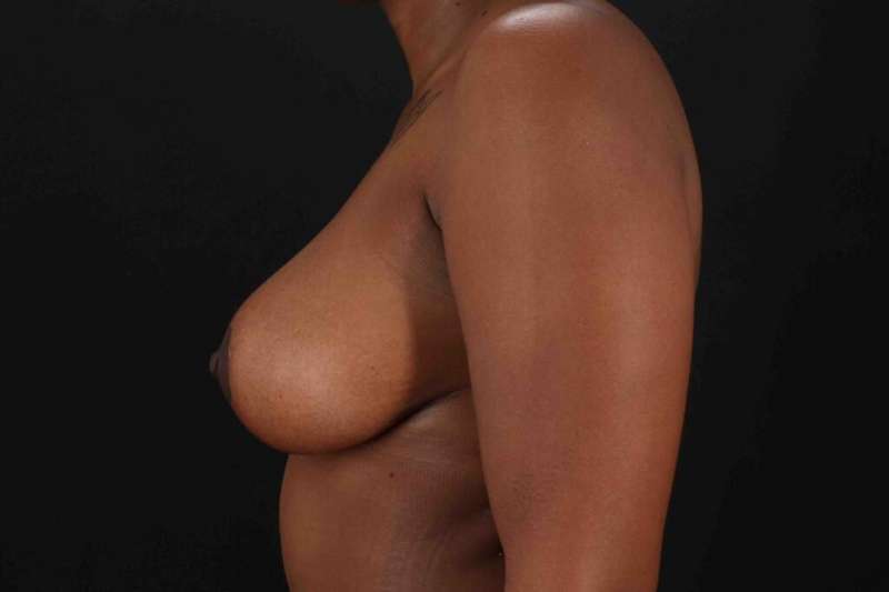 Breast Lift Before & After Patient #3875