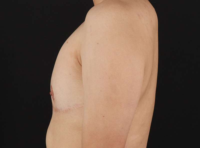 Female To Male Breast Before & After Patient #3944