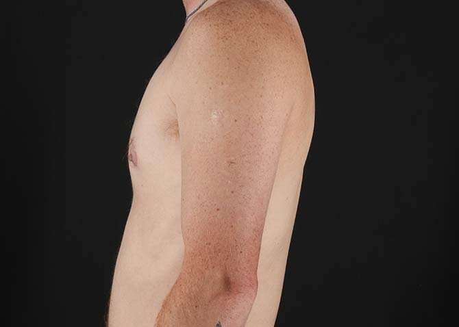 Female To Male Breast Before & After Patient #3955