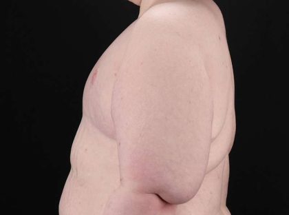 Female To Male Breast Before & After Patient #3966