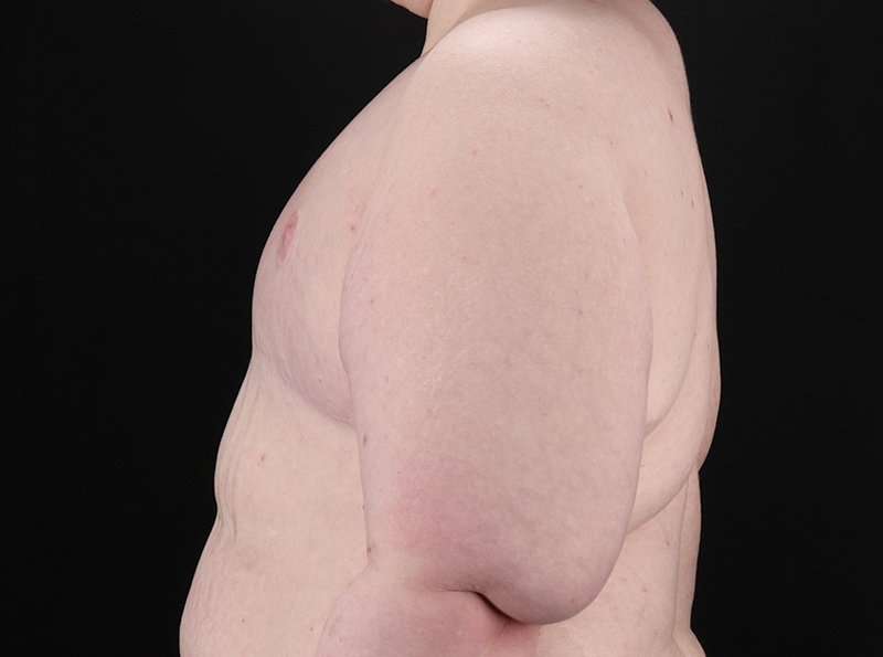 Female To Male Breast Before & After Patient #3966