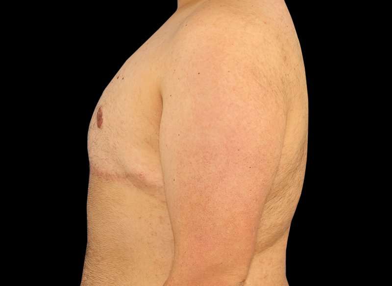 Female To Male Breast Before & After Patient #3977