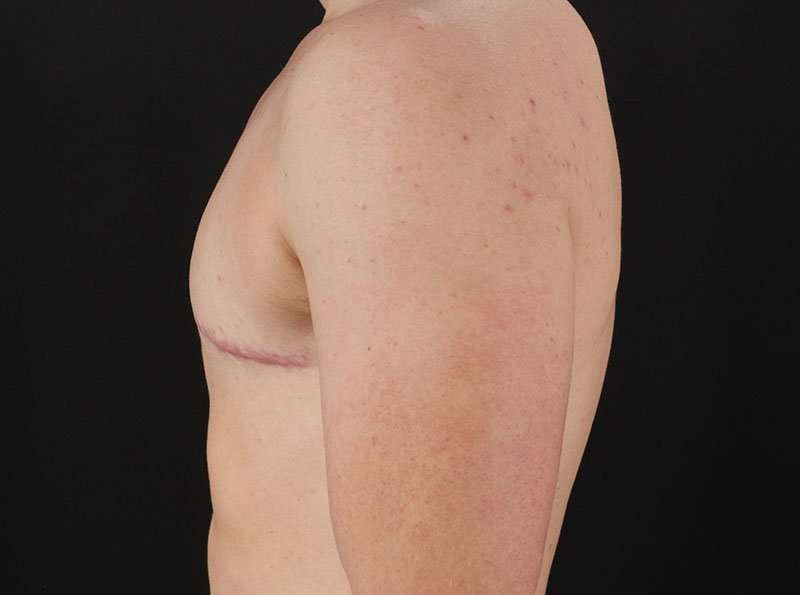 Female To Male Breast Before & After Patient #4009
