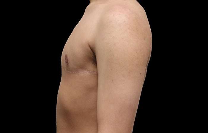 Female To Male Breast Before & After Patient #4020