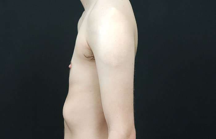 Female To Male Breast Before & After Patient #4031